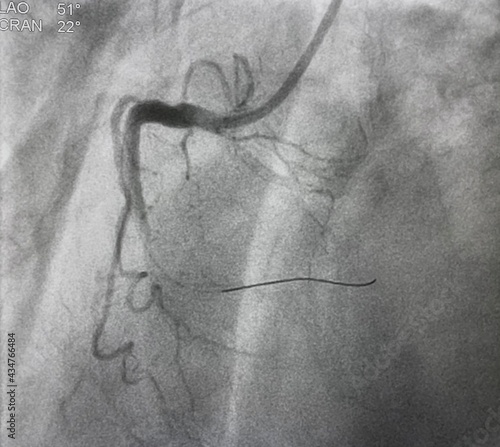 Fotografi coronary angiogram shown massive thrombus that occluded right coronary artery (RCA) in patient with ST elevation myocardial infarction (STEMI) with no-reflow