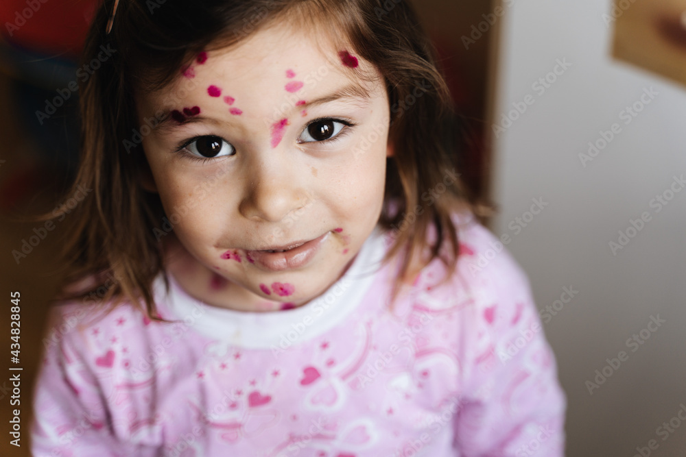 Toddler girl with chickenpox measles on the body. Varicella virus childhood contagious disease. Itchy red blisters, fever, pain symptoms. Toddler girl with chickenpox measles on the body. Varicella virus childhood contagious disease. Itchy red blisters, fever, pain symptoms.