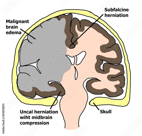 Brain swelliong in ischemic stroke pateint whixh can cause cerebral herniation. photo