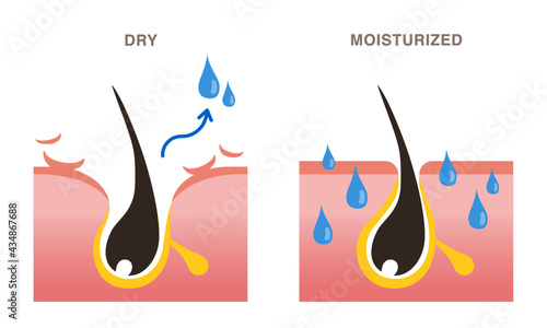 Skin cross section of pore types. Moisturized pore and dry pore. Pale colored illustration in flat cartoon style.