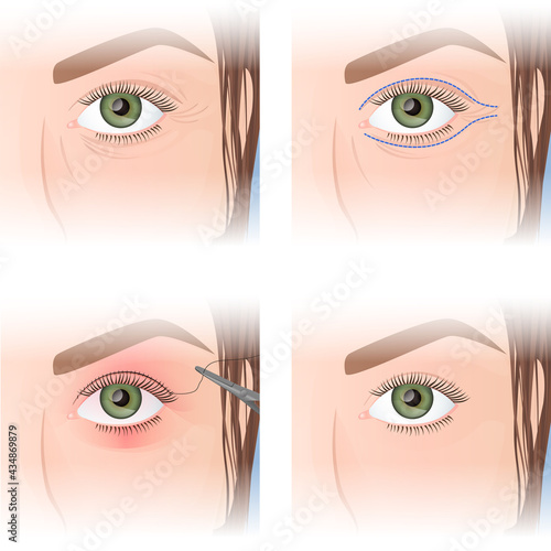 blepharoplasty, upper eyelid plastic, before and after images