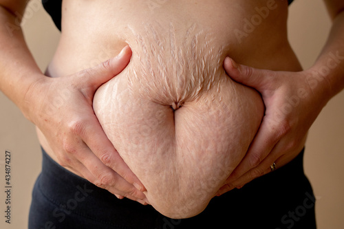 woman holding her fat belly with stretch marks