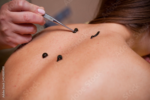 Tableau sur toile hirudotherapy procedure