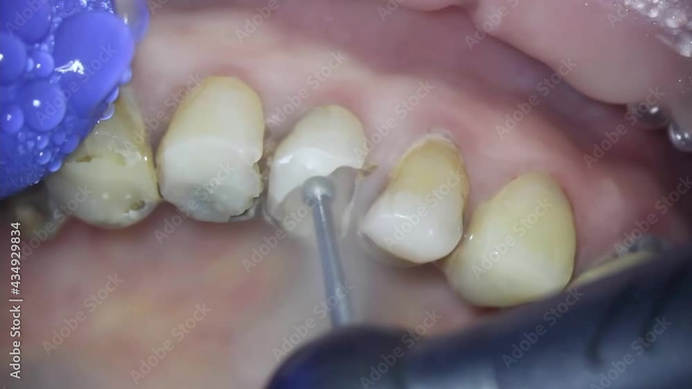 dentistry. shooting with a microscope. necrectomy. the dentist removes
