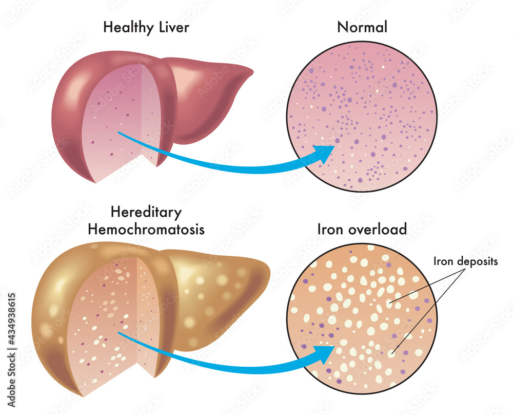 Medical illustration shows the difference between a healthy liver and