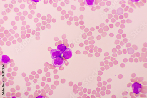 Acute promyelocytic leukemia cells or APL  analyze by microscope  original magnification 1000x