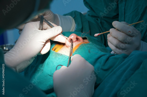 Doctors and nasal surgery assistants make incisions on the nose.