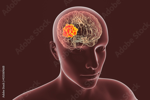Foto Brain mucormycosis, a brain lesion caused by fungi Mucor