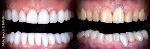 Perfect smile whitening before and after veneers bleach of zircon arch ceramic prothesis . Implants crowns. Dental restoration treatment clinic patient . Oral Care concept surgery procedure dentistry
