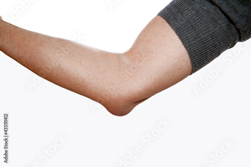 Arm of a man with olecranon bursitis at the tip of his elbow.