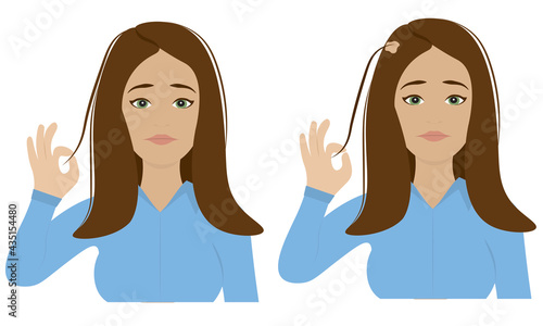 Woman with Trichotillomania - Hair pulling disorder