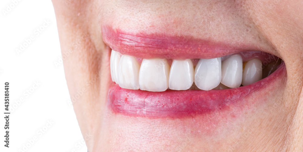 Obraz premium teeth treatments with crowns and venners