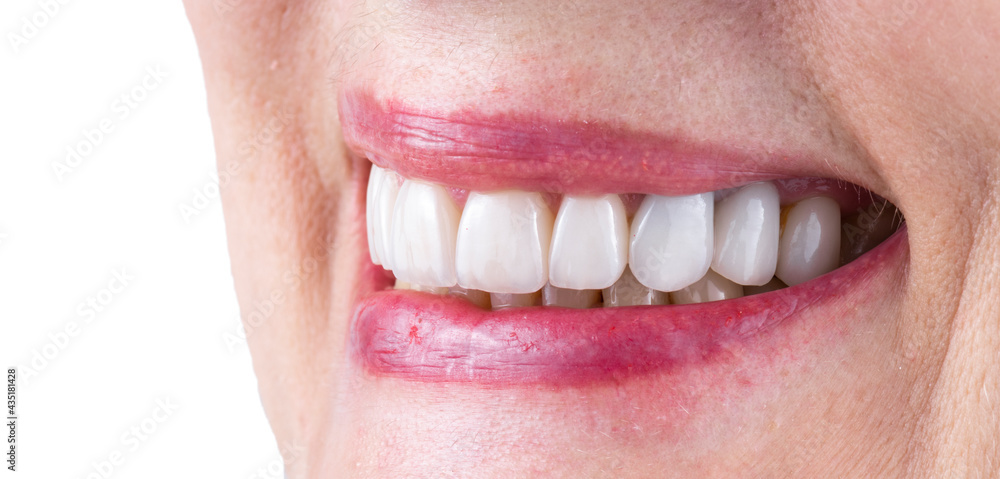 Obraz premium teeth treatments with crowns and venners