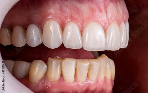 teeth treatments with crowns and venners