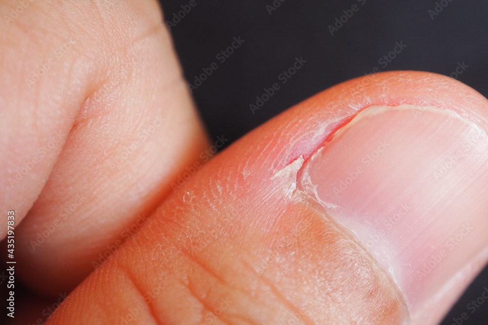 Close Finger Injury After Nail Biting Stock Photo 1350763217 | Shutterstock