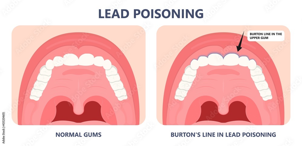 Lead Iron Heavy Metal Lead Iron toxic industry water air food based paint brain ...