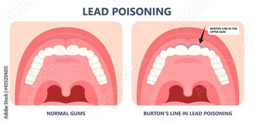Heavy Metal Lead Iron toxic industry water air food based paint brain cancer kidney health human environmental contamination power plant risk danger fish Drink line test kids level lab poison waste
