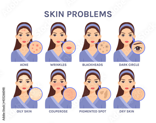 Beautiful cartoon Woman and Skin Problems.Portrait of a Girl and close-up of facial Diseases: Acne, Blackheads, Wrinkles, Dark circles, Oily skin, Couperose, Pigmented spota, Dry. Vector.