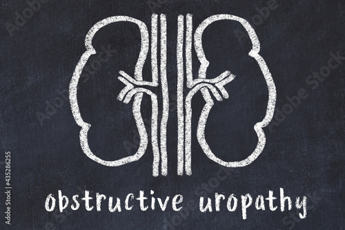 Chalk drawing of human kidneys and medical term obstructive uropathy. Concept of learning medicine