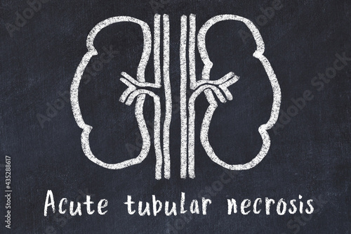 Chalk drawing of human kidneys and medical term Acute tubular necrosis. Concept of learning medicine