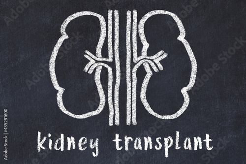 Chalk drawing of human kidneys and medical term kidney transplant. Concept of learning medicine photo