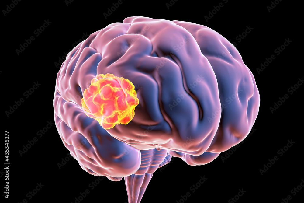 Brain Mucormycosis A Brain Lesion Caused By Fungi Mucor Also Known As brain-mucormycosis-a-brain-lesion-caused-by-fungi-mucor-also-known-as