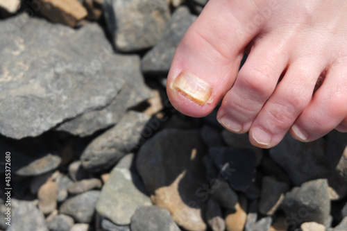 фотографія Fungal nail disease