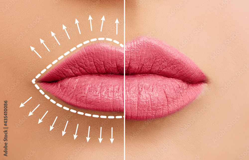 Lip augmentation concept. Woman lips before and after lip filler injections - obrazy, fototapety, plakaty 