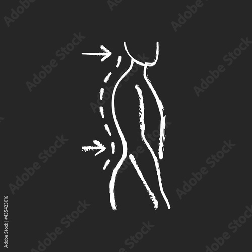 Lumbar lordosis chalk white icon on black background. Excessive inward spine curve. Saddleback appearance. Pain, discomfort. Difficulty with coordination. Isolated vector chalkboard illustration photo