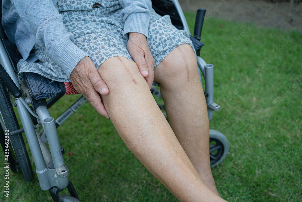 Asian senior or elderly old lady woman patient show her scars surgical total knee joint replacement Suture wound surgery arthroplasty on bed in nursing hospital ward, healthy strong medical concept.