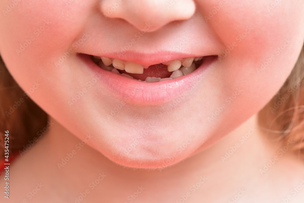 Child smile with first baby tooth that has fallen out Child smile with first baby tooth that has fallen out