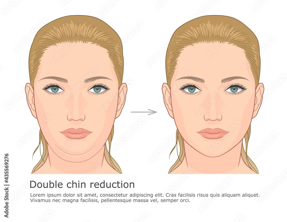 Double chin fat loss front view before and after vector illustration.
Double chin fat loss front view before and after vector illustration.
