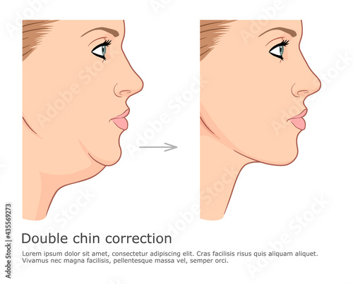 Fat chin and neck correction before and after. Double chin fat loss vector illustration. photo