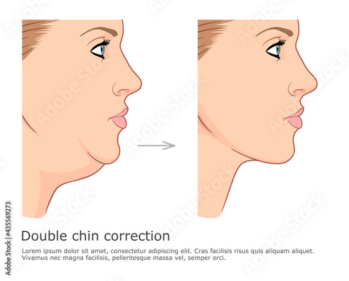 Fat chin and neck correction before and after. Double chin fat loss vector illustration.