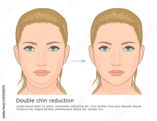 Double chin fat loss front view before and after vector illustration.
