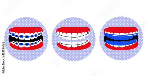 Dental braces, essix aligner or orthodontic Hawley retainer on teeth.Poster in pop art style.Oral care and daily routine.Bite correction.Cavity disease.False jaw.Bruxism treatment.Vector