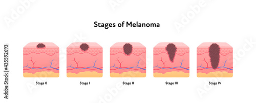 Melanoma cancer anatomical infographic poster. Vector flat medical illustration. Stages of tumor disease. Design for healthcare, oncology, dermatology.