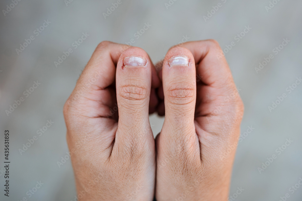 Close up detail of two hands together with thumbs with white and bitten nails Close up detail of two hands together with thumbs with white and bitten nails