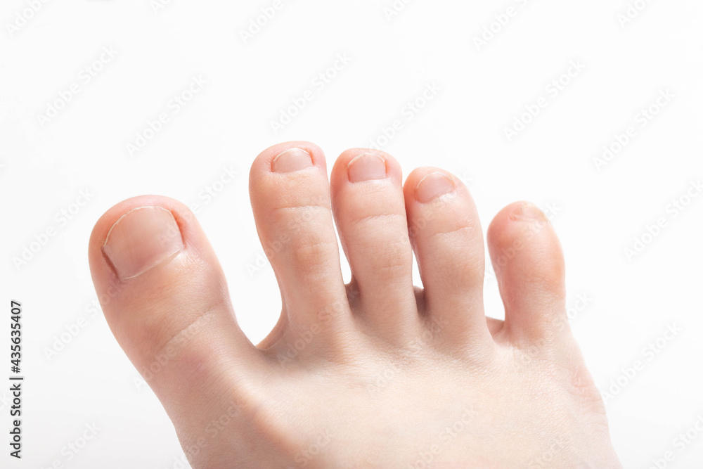 Toes on a white background. Concept of unpleasant foot odor, bacteria and fungus between the toes Toes on a white background. Concept of unpleasant foot odor, bacteria and fungus between the toes