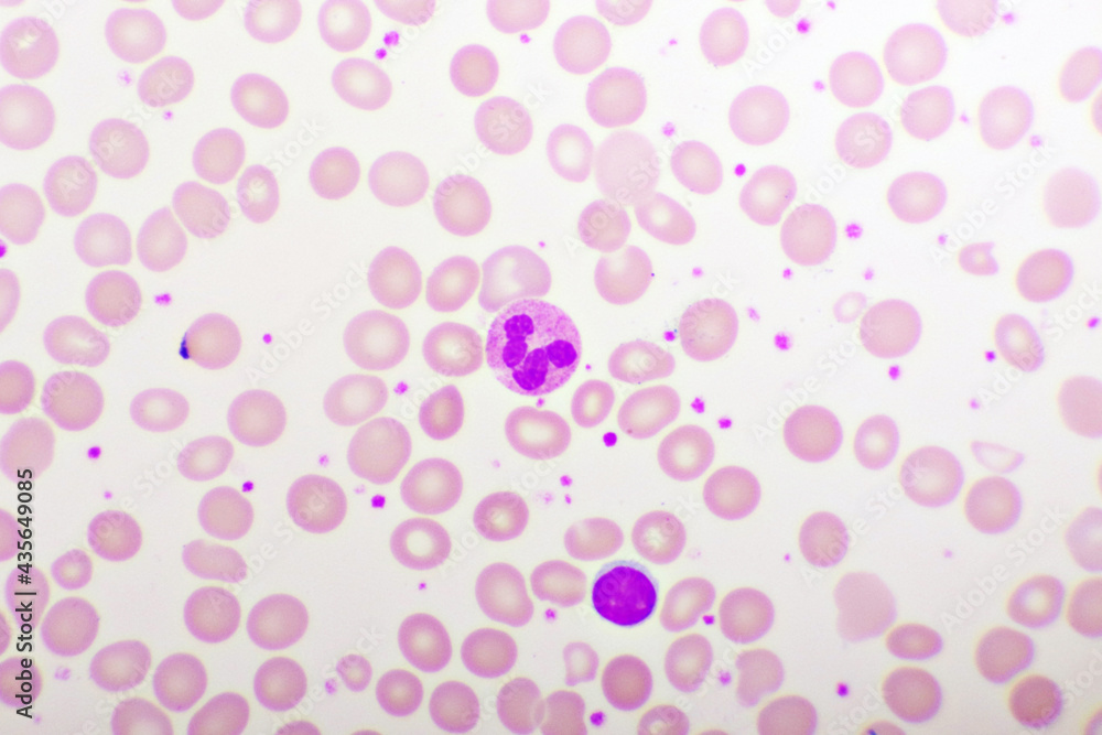 Essential thrombocytosis blood smear, present abnormal high platelet and white blood cell, analyze by microscope