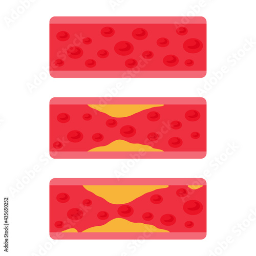 Vascular vectors. Fat arteries clog the blood flow in the body. It is most common in obese patients.