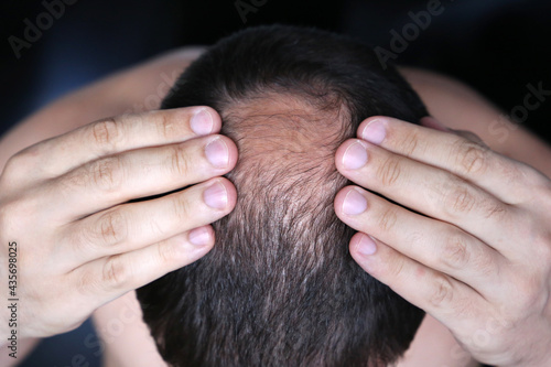 Baldness, man concerned about hair loss. Male head with a bald