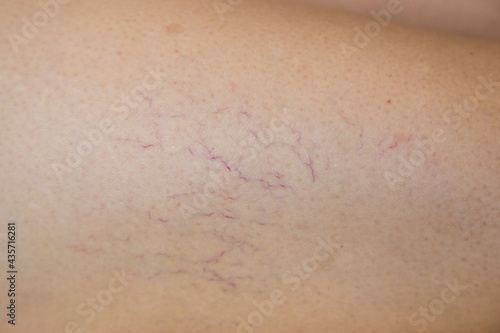 Spider veins on leg. Varicose veins. swelling of the veins on the legs
