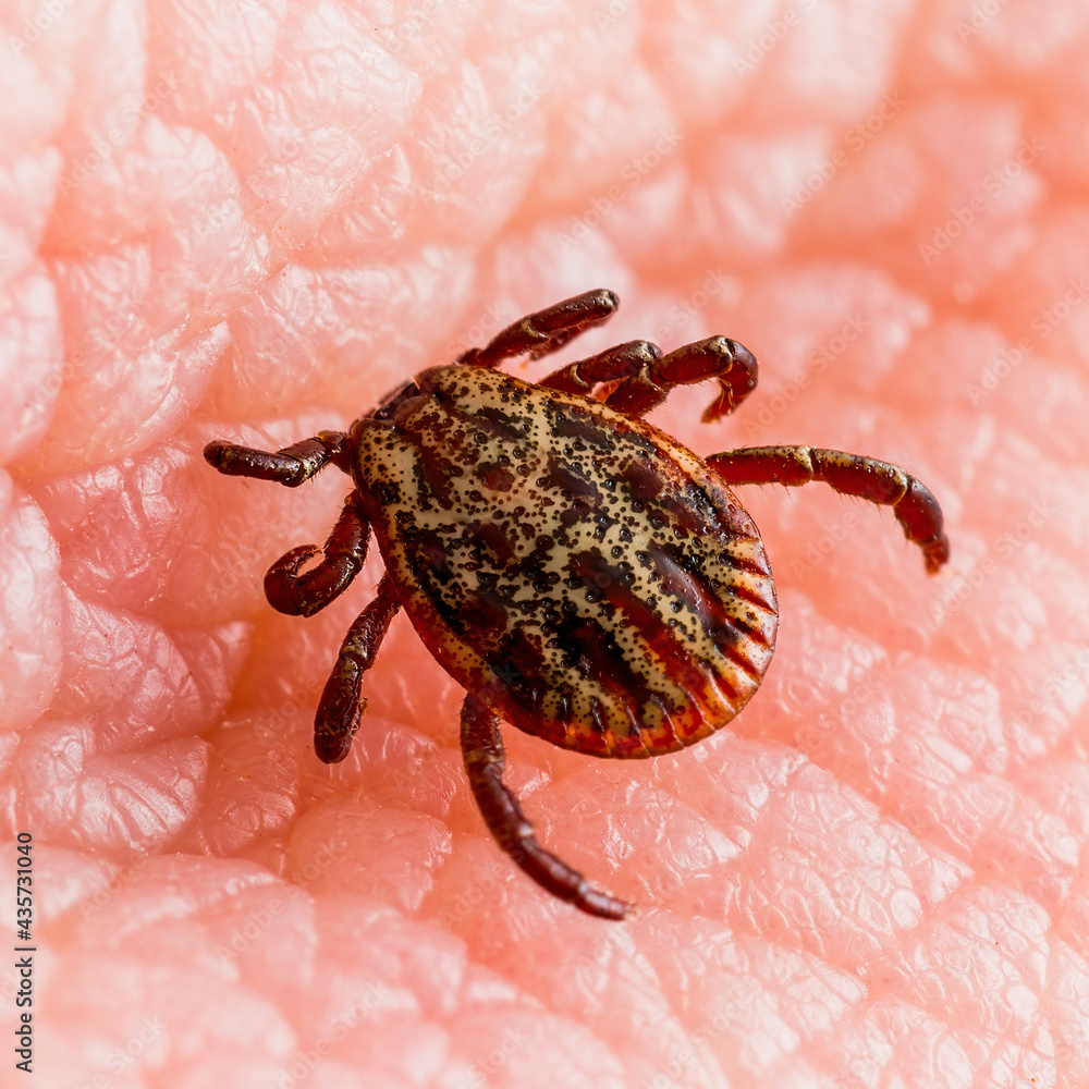 Infectious Encephalitis Tick Insect on Skin. Encephalitis Virus or Lyme Borreliosis Disease Infected Dermacentor Tick Arachnid Parasite Bite. Infectious Encephalitis Tick Insect on Skin. Encephalitis Virus or Lyme Borreliosis Disease Infected Dermacentor Tick Arachnid Parasite Bite.
