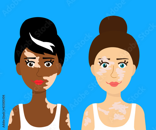 Women with vitiligo and different eye colors. Portrait. Vector illustration.