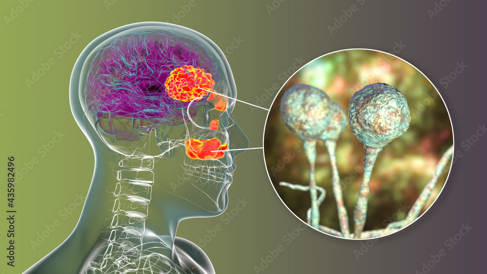 Rhinocerebral mucormycosis, a brain lesion and sinusitis caused by