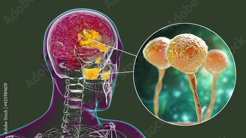 Rhinocerebral mucormycosis, a brain lesion and sinusitis caused by fungi Mucor photo