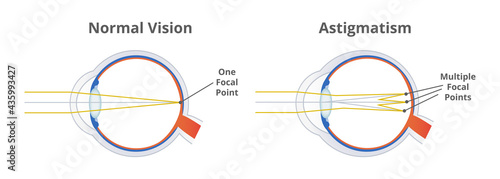 Astigmatism, refractive or refraction error. Eye disorder, eye does not focus light evenly on the retina. Blurry, blurred, or distorted vision. The illustration is isolated on a white background. 