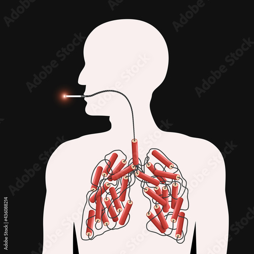 Smoke kills poster, metaphorical depiction of dangers of smoking where lighted cigarette continues as a fuse to dynamite in the lungs of a human figure, quite smoking concept