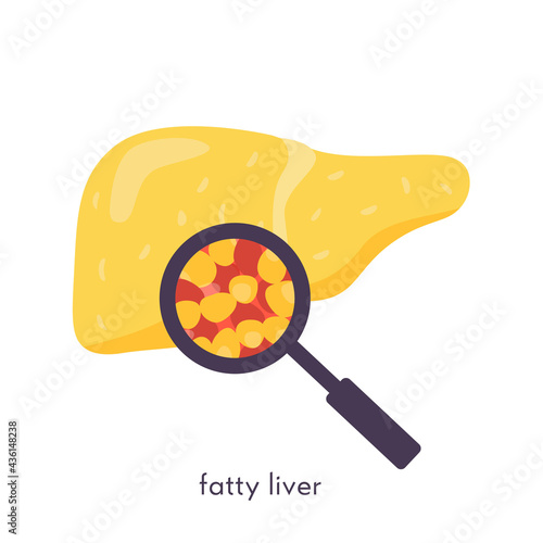 Unhealthy fatty liver. Damaged human organ under magnifying glass. Medical research study of fat liver tissue. Vector illustration in flat cartoon style isolated on white.